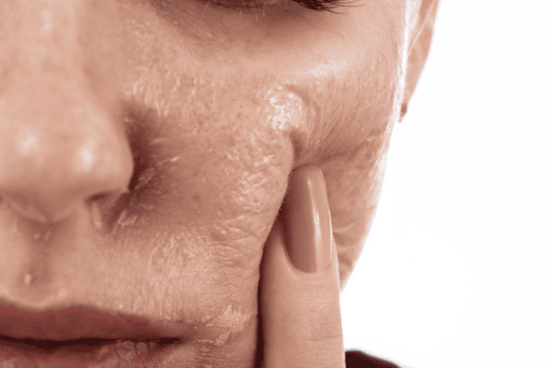 VI Facial Peels Treatment | The Natural Aesthetic Medspa in Sykesville, MD
